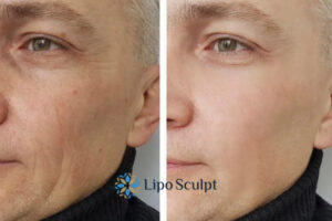 How to Fight Aging Symptoms 3 Fight Aging Symptoms West Midlands With HIFU and Morpheus8 Today!
