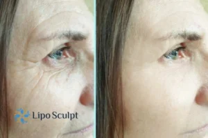 How to Fight Aging Symptoms 2 Do you want to Fight Aging Symptoms West Midlands? Contact Lipo Sculpt today!