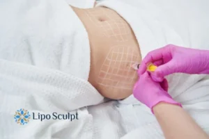 Are The Results From Aqualyx Permanent? 1 Do you want to know how long Aqualyx West Midlands results last?