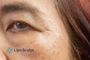 Cryopen: The Revolutionary Treatment for Age Spots Unveiled 2 Are age spots West Midlands giving you low self esteem? Contact us today!