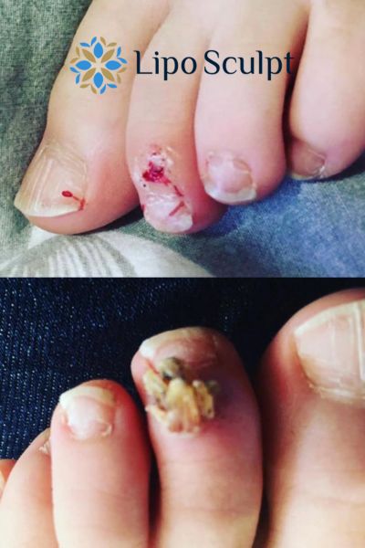 Wart removal customer results from Lipo Sculpt West Midlands