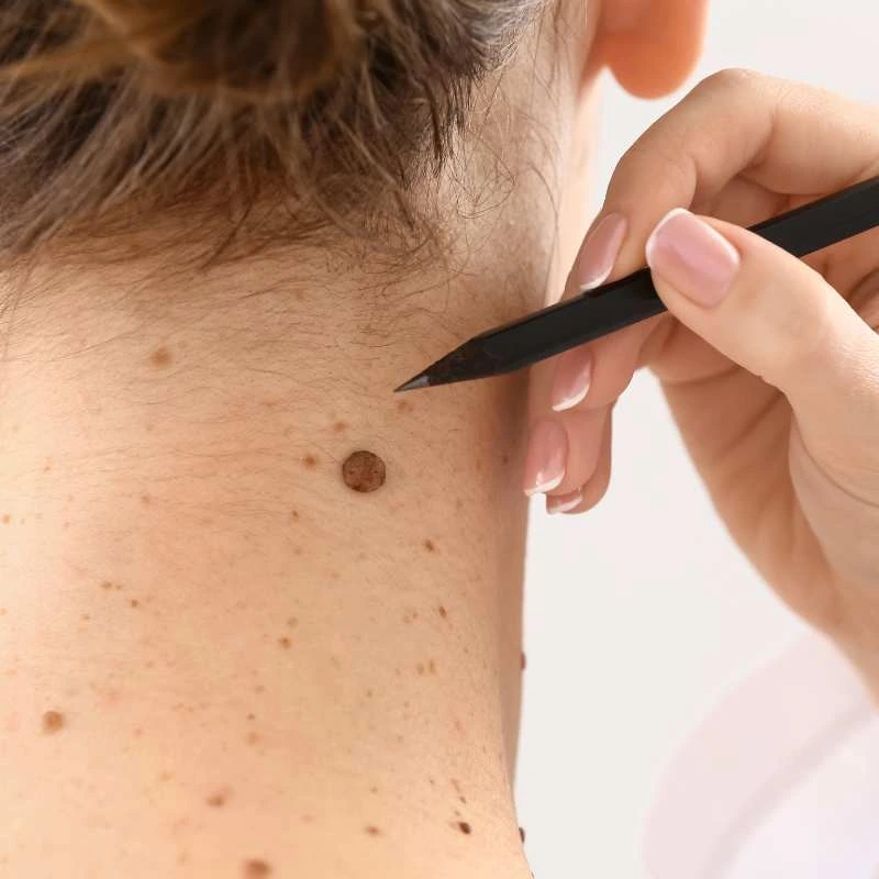 How to Support Your Body During Pregnancy for Faster Postnatal Recovery 5 See our lesion removal prices West Midlands - call today for a free quote
